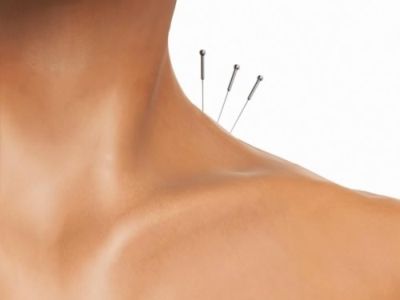 Adelgazar con la acupuntura